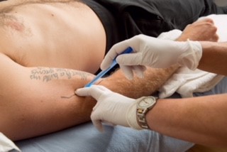 dry needling course