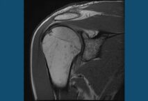 thawing a frozen shoulder with acupuncture