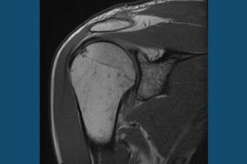 thawing a frozen shoulder with acupuncture