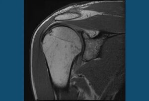 thawing a frozen shoulder with acupuncture