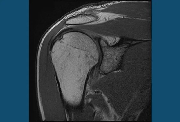 thawing a frozen shoulder with acupuncture